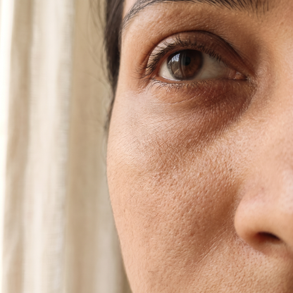 Under-eye pigmentation close-up